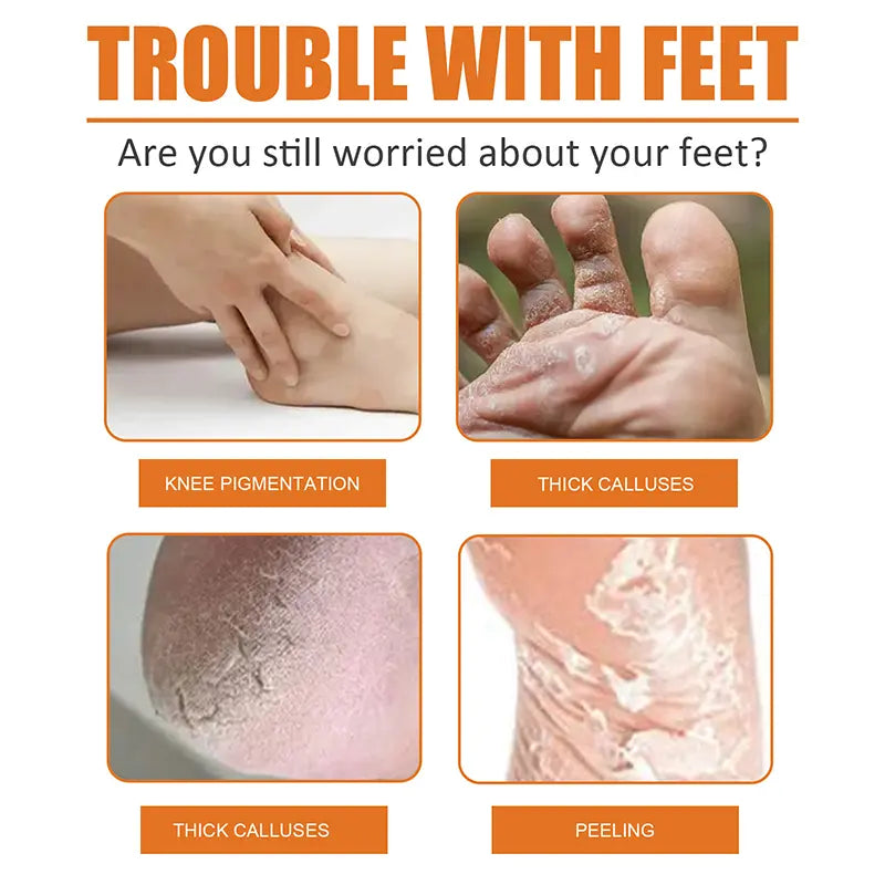 Foot Callus Removal Spray