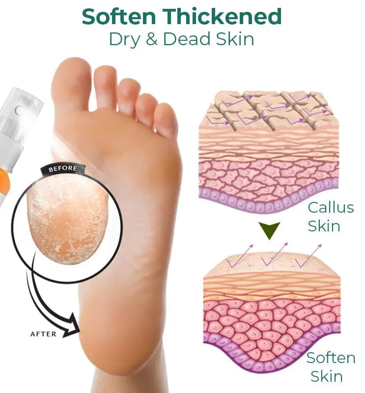 Foot Callus Removal Spray
